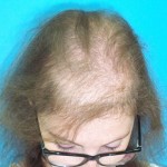 Mujer antes de recibir tratamiento capilar para alopecia imagen frontal