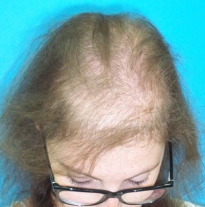 Mujer antes de recibir tratamiento capilar para alopecia imagen frontal