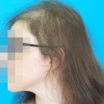 Mujer antes de recibir tratamiento capilar para alopecia imagen lado izquierdo