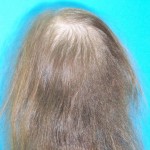 Mujer antes de recibir tratamiento capilar para la alopecia imagen parte de atrás