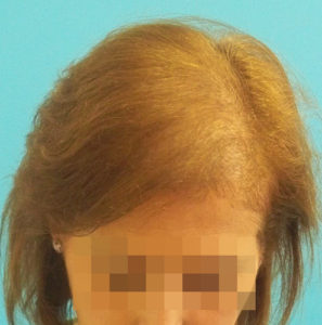 Mujer antes de recibir sistemas de cabello natural Hair & Hair imagen frontal