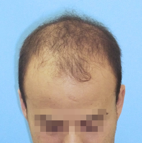 Hombre con primeros síntomas de pérdida de cabello antes de realizar un microinjerto capilar imagen grande