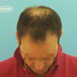 Imagen frontal grande de un hombre con primeros síntomas de alopecia avanzada antes de un microinjerto capilar