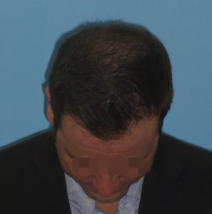 Imagen frontal de un hombre con primeros síntomas de alopecia avanzada después de un microinjerto capilar