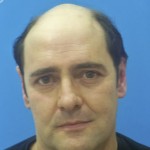 Hombre con alopecia avanzada previo a recibir sistemas Hair & Hair imagen