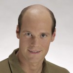 Hombre con alopecia avanzada antes de recibir sistemas de integración capilar imagen