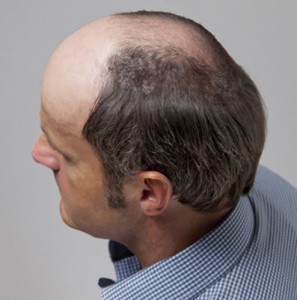 Hombre con alopecia avanzada ante de recibir Hair & Hair sistema de cabello natural imagen lateral