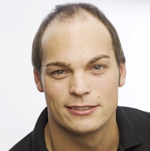 Imagen de un hombre con alopecia avanzada antes de recibir integración capilar