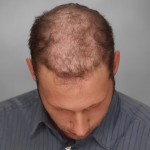 Hombre con alopecia avanzada antes de una integración capilar imagen frontal 
