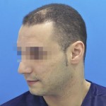 Hombre con caída del cuero cabelludo antes de recibir un microinjerto capilar imagen