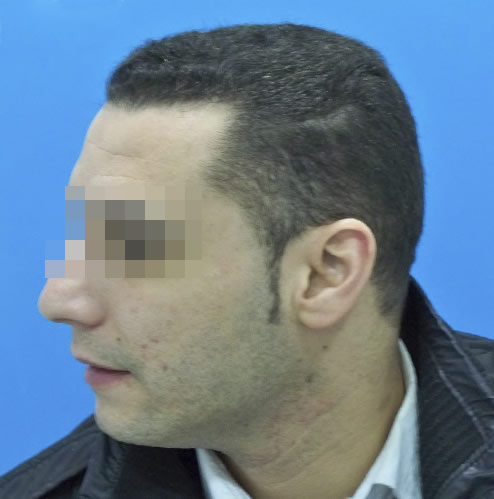Hombre con caída del cuero cabelludo después de recibir un microinjerto capilar