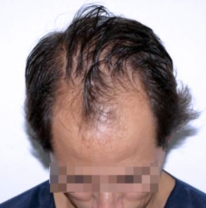 Hombre con caída capilar antes de recibir un microinjerto imagen frontal