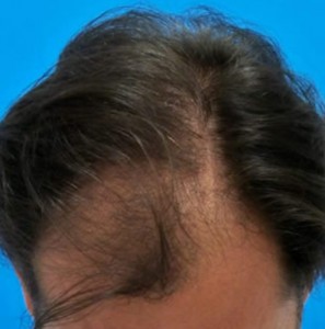 Hombre con pérdida de pelo antes de someterse a un trasplante capilar