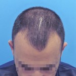 Hombre con primeros síntomas de pérdida de cabello antes de realizar un microinjerto imagen