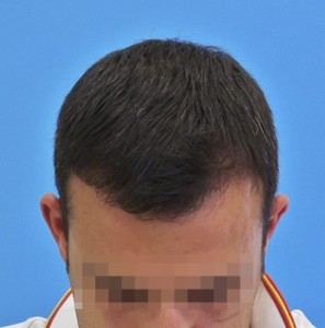 Hombre tras recibir microinjerto capilar