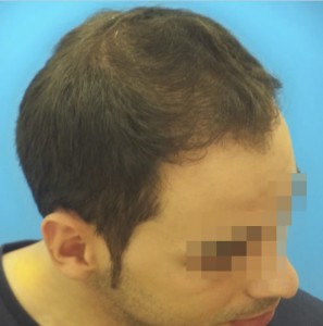 Hombre con primeros síntomas visibles antes del tratamiento capilar 