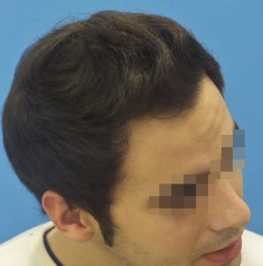 Hombre con primeros síntomas visibles después del tratamiento capilar 