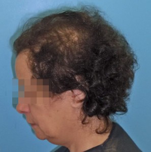 Mujer con alopecia avanzada imagen grande previa a recibir microinjerto