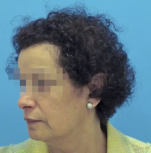 Mujer con alopecia avanzada después de recibir microinjerto
