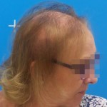Imagen de una mujer con alopecia avanzada previa a recibir un sistema Hair & Hair
