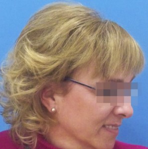 Mujer con alopecia avanzada después de recibir sistemas Hair & Hair