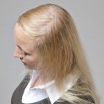 Mujer con alopecia avanzada imagen previa a recibir sistemas de cabello natural Hair & Hair