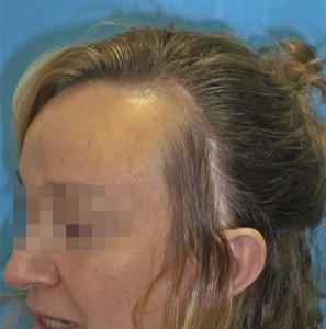 Mujer con problemas capilares antes de realizar un microinjerto imagen