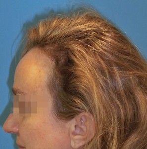 Mujer con problemas capilares después de realizar un microinjerto