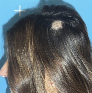 Imagen del cuero cabelludo de una mujer previo a recibir tratamiento capilar