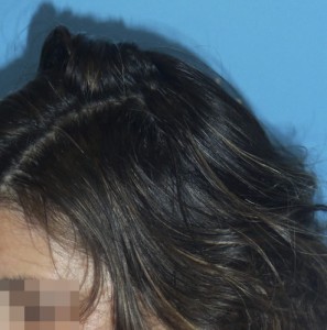 Imagen del cuero cabelludo de una mujer después de recibir tratamiento capilar