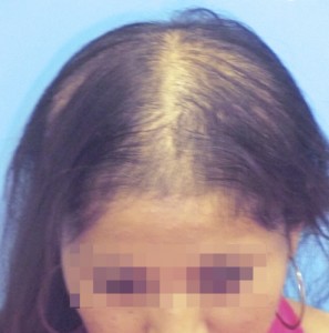 Imagen de una mujer previa a recibir un tratamiento-cosméticos capilar