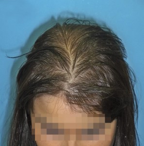 Imagen grande de mujer con síntomas visibles de pérdida de cabello antes de recibir microinjerto capilar 