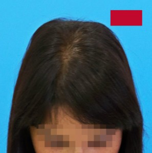 Imagen de mujer después de recibir microinjerto capilar