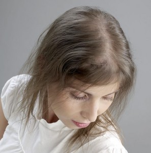 Mujer con síntomas visibles de alopecia antes de recibir sistemas de cabello natural Hair & Hair imagen