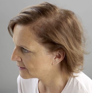 Mujer con síntomas de alopecia antes de recibir sistemas de cabello natural Hair & Hair imagen