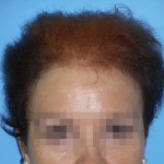 Mujer con síntomas visibles de alopecia avanzada antes de recibir sistema Hair & Hair imagen