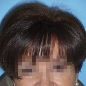 Mujer con síntomas visibles de alopecia avanzada después de recibir sistema Hair & Hair