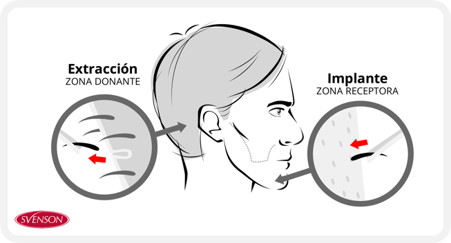 Proceso del injerto de barba (extracción e implante)
