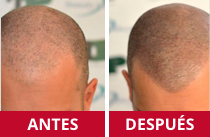Micropigmentación efecto rapado (antes y después) en la clínica Svenson de Madrid